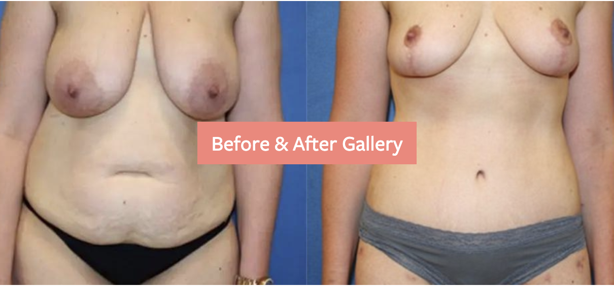 Mommy makeover before and after gallery